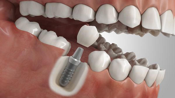 Illustration eines Implantats als Ersatz für einen Einzalzahn